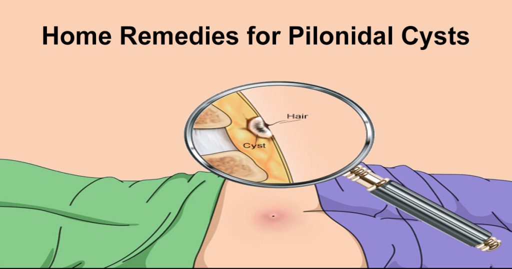 Home remedies for pilonidal cysts